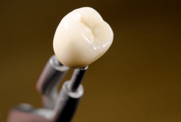 FAQs About Dental Crowns