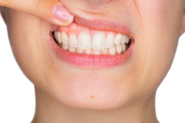 The Types Of Gum Disease
