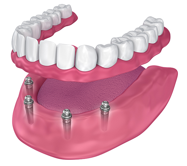 Hackensack All-on-4 Implants