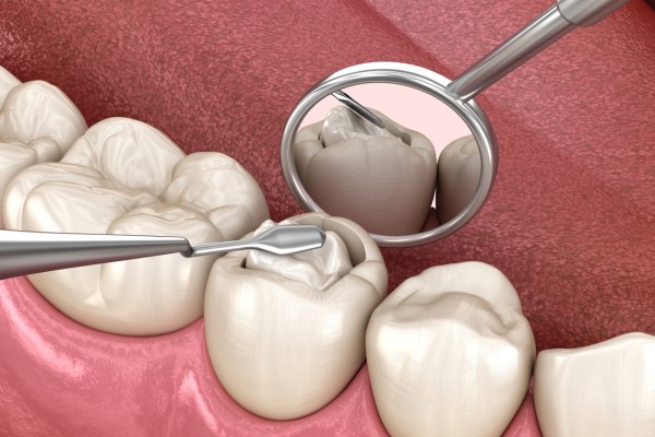 How Does A Dental Filling Work?