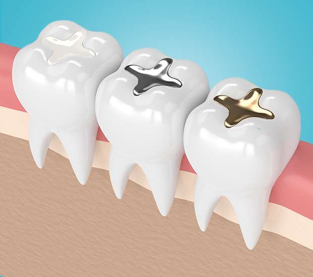 Hackensack Composite Fillings