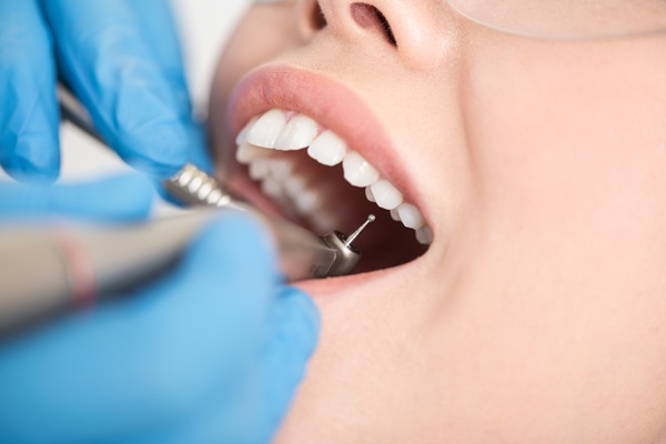 Dental Fillings: Restoring Teeth Affected By Cavities And Decay