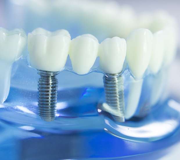 Hackensack Dental Implants