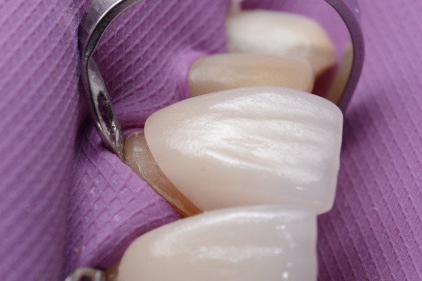 How Veneers Can Improve Teeth Appearance
