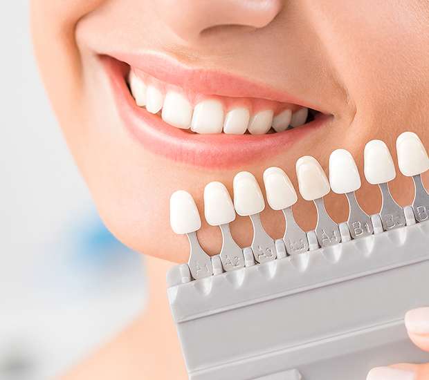 Hackensack Dental Veneers and Dental Laminates