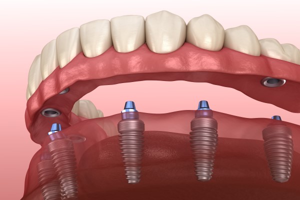 Implant Supported Dentures Hackensack, NJ