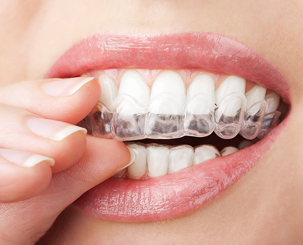 Why You Should Visit an Invisalign Dentist Office - Rolando Cibischino D.M.D Hackensack New Jersey