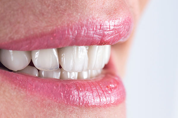How To Prevent Cavities Under Veneers