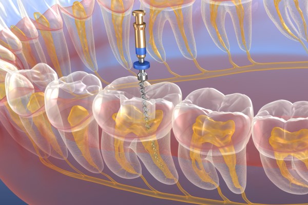 Root Canal Treatment Hackensack, NJ
