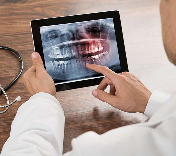 Hackensack Types of Dental Root Fractures