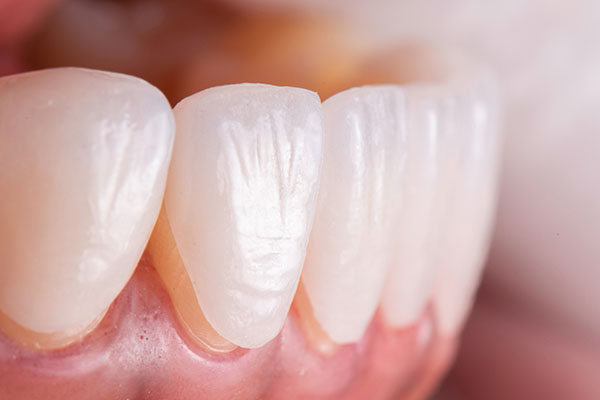 Using Veneers To Close Gaps Between Teeth